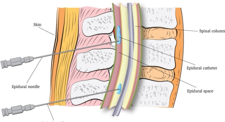 Coding guide for Epidural Infusion, Catheter and Pump implantation CPT codes