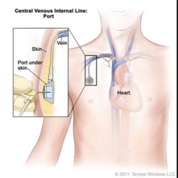 Secret Tricks to code Cpt Code for catheter placement