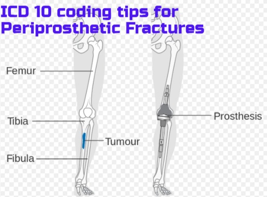 How to code Periprosthetic fractures in ICD 10