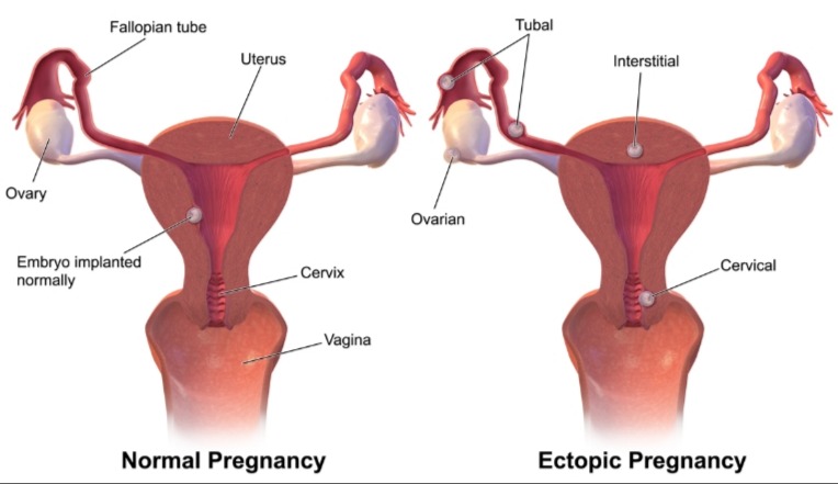 Coding tips for Ectopic and Molar Pregnancy ICD 10, CPT & ICD 10 PCS codes