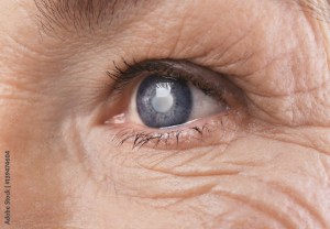 Cataract a vision condition