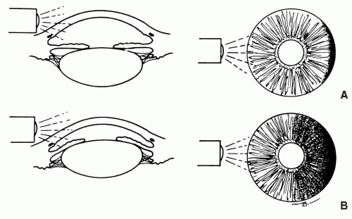 Ocular Disorder | Anesthesia Key