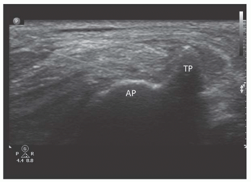Ultrasound-Guided Third Occipital Nerve Block and Cervical Medial ...