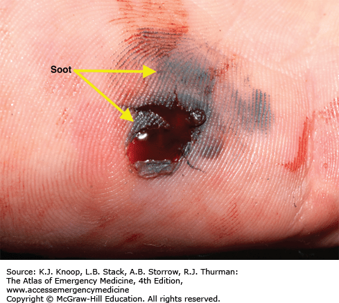 They are more extensive in solid,. CLINICAL FORENSIC MEDICINE | Anesthesia Key