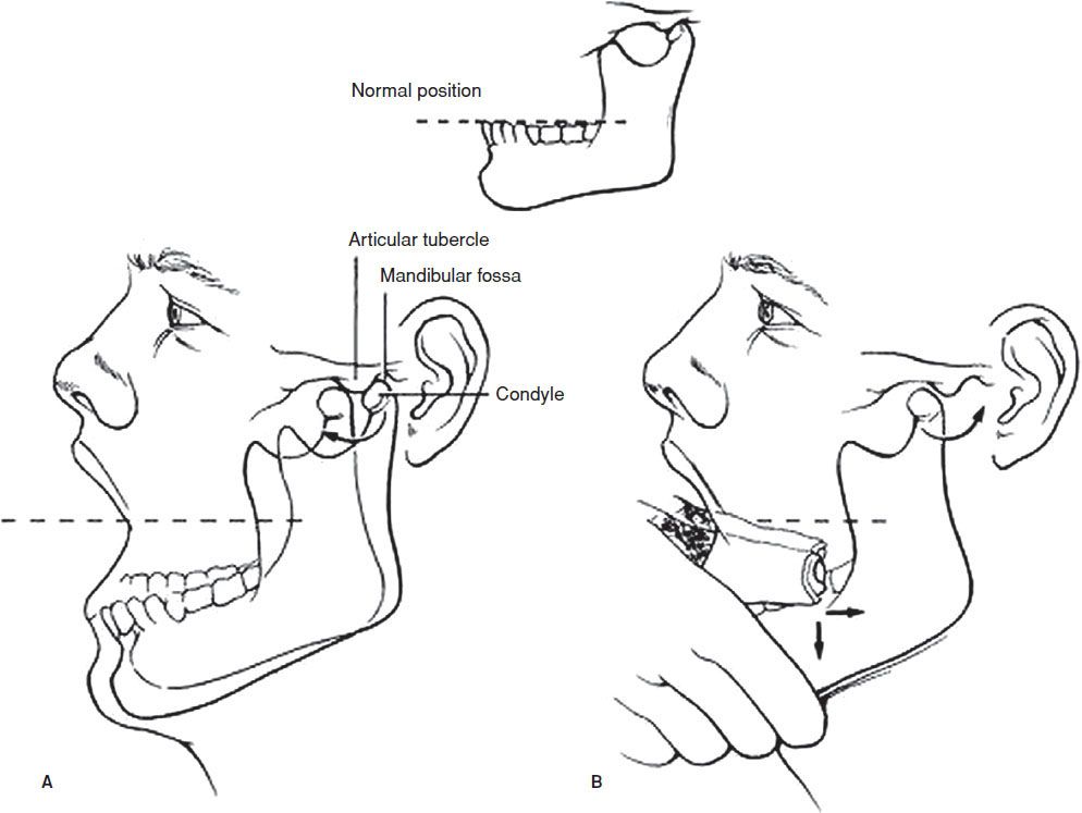 Temporomandibular Pain and Dislocation Anesthesia Key