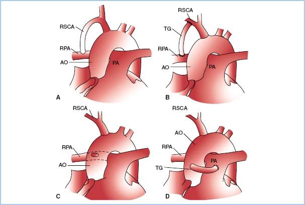 Anesthetic Management for Patients with Congenital Heart Disease
