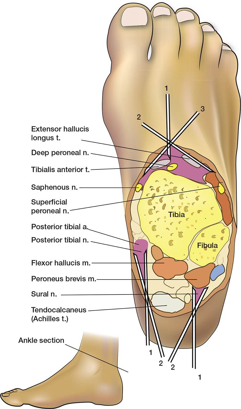 Ankle and Foot Nerve Blocks Anesthesia Key