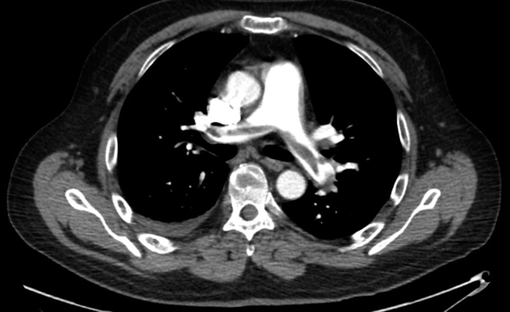A a pe is a blood clot or blood clots which have travelled to the lungs, usually from a deep vein thrombosis (dvt) of one of the deep veins . Deep Venous Thrombosis and Pulmonary Embolism in the