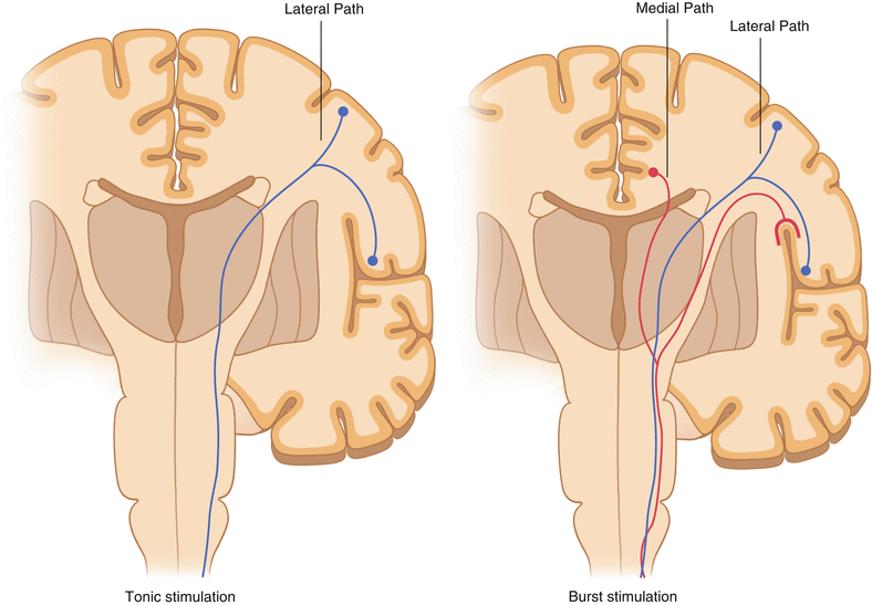 Burst Stimulation An Innovative Waveform Strategy for Spinal Cord