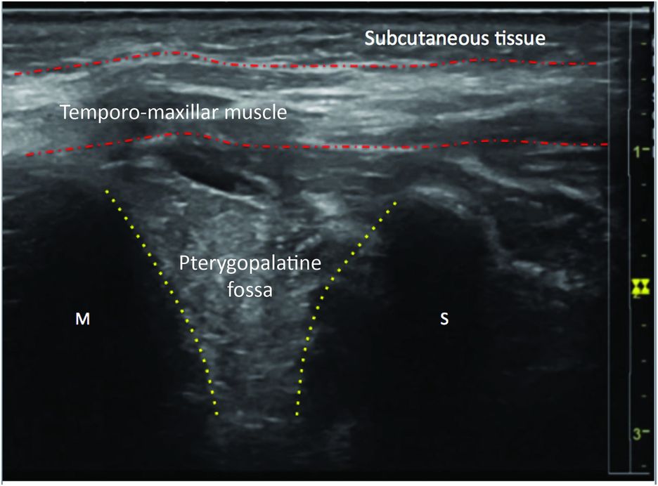 Ultrasoundguided facial blocks Anesthesia Key