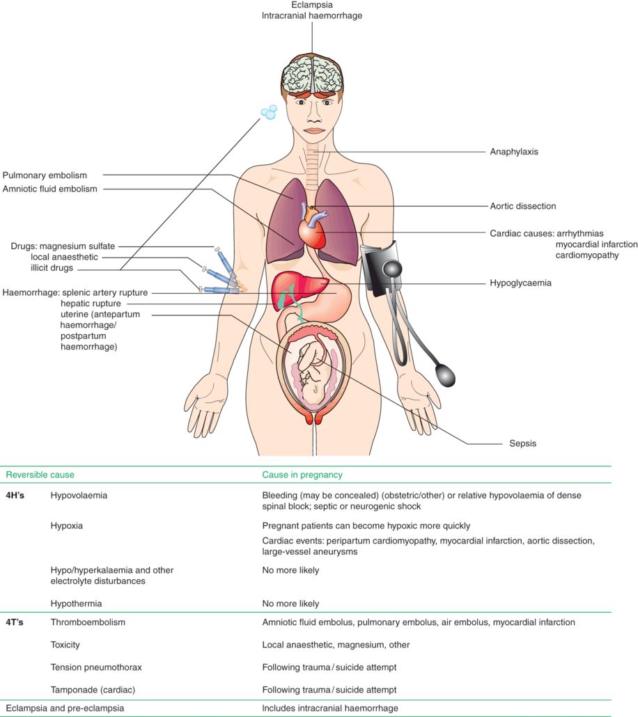Maternal collapse, including massive obstetric haemorrhage, amniotic ...
