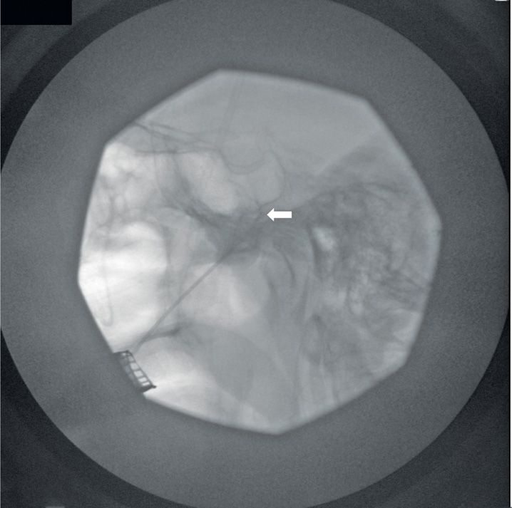 Trigeminal Ganglion and Nerve Block Anesthesia Key