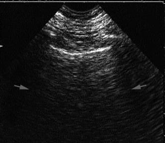The A-Profile (Normal Lung Surface): 1) The A-Line | Anesthesia Key