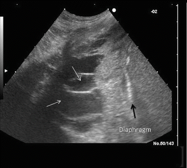 The Role of Lung Ultrasound on the Daily Assessment of the Critically ...