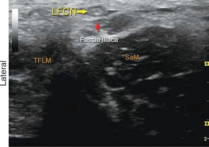 Lateral Femoral Cutaneous Nerve Block | Anesthesia Key