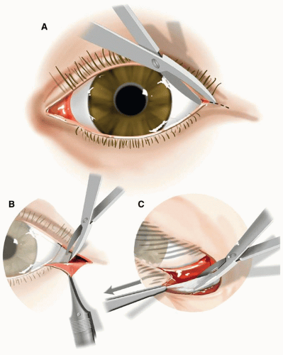 Ophthalmologic Surgical Patient | Anesthesia Key