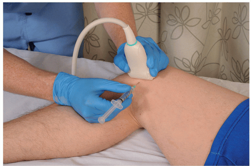 Ultrasound-Guided Injection Technique for Intra-articular Injection of ...