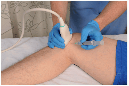 Ultrasound-Guided Injection Technique for Coronary Ligament Pain ...
