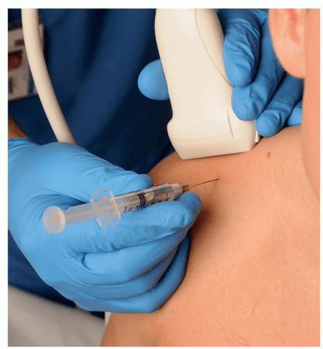 Ultrasound-Guided Injection Technique for Rotator Cuff Disease ...