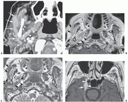 Ultrasound-Guided Auriculotemporal Nerve Block | Anesthesia Key