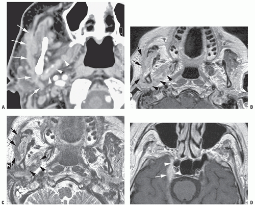 Ultrasound-Guided Auriculotemporal Nerve Block | Anesthesia Key