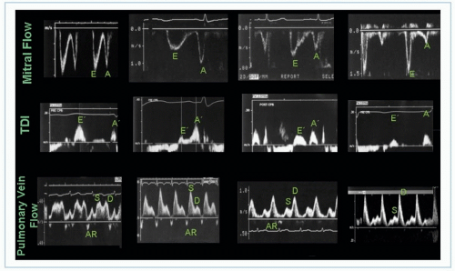 Echocardiographic Evaluation of Ventricular Diastolic Function ...