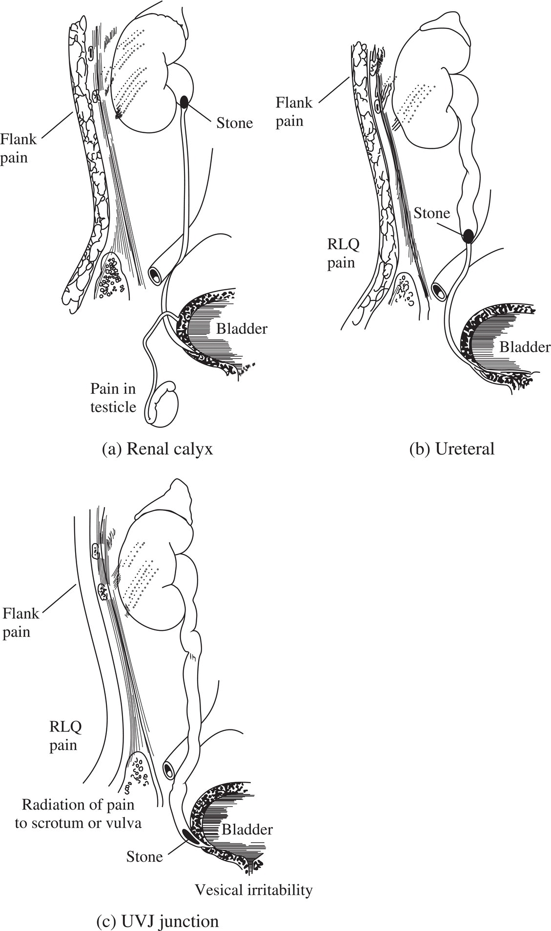 Nephrolithiasis Anesthesia Key