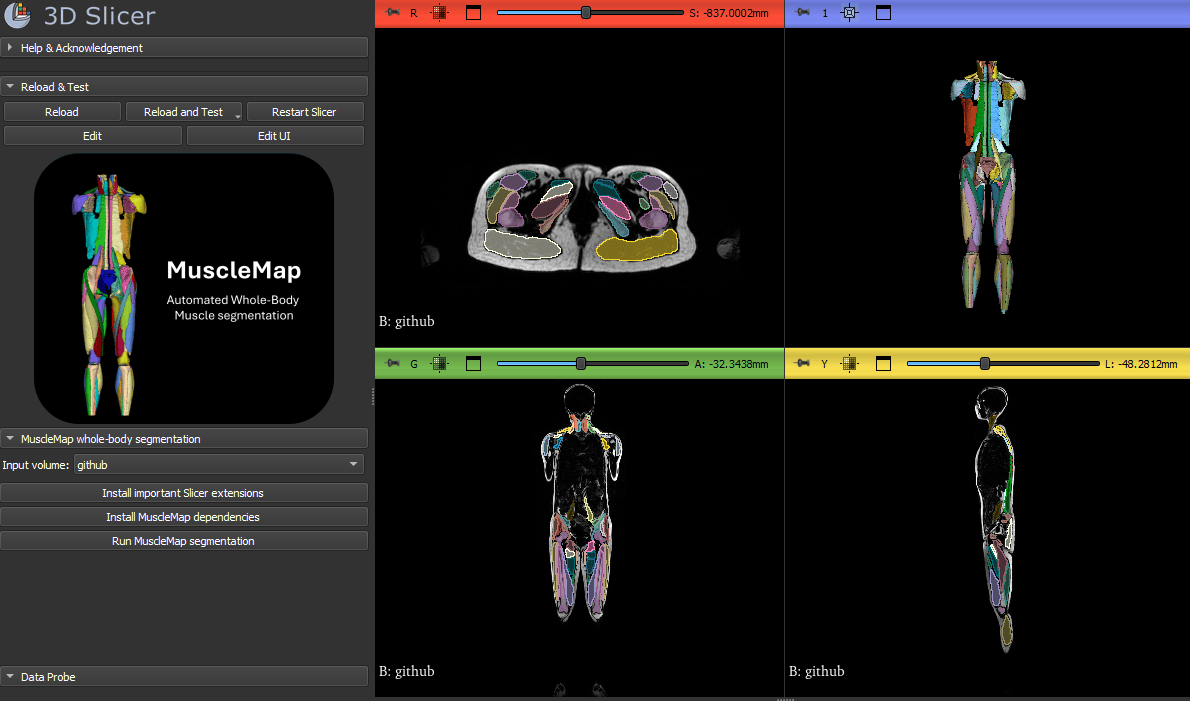 From Medical Scans To Muscle Biomarkers MuscleMap Drives Early Disease Musclemap Suggested Image 2 