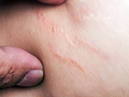 Stretch Marks
