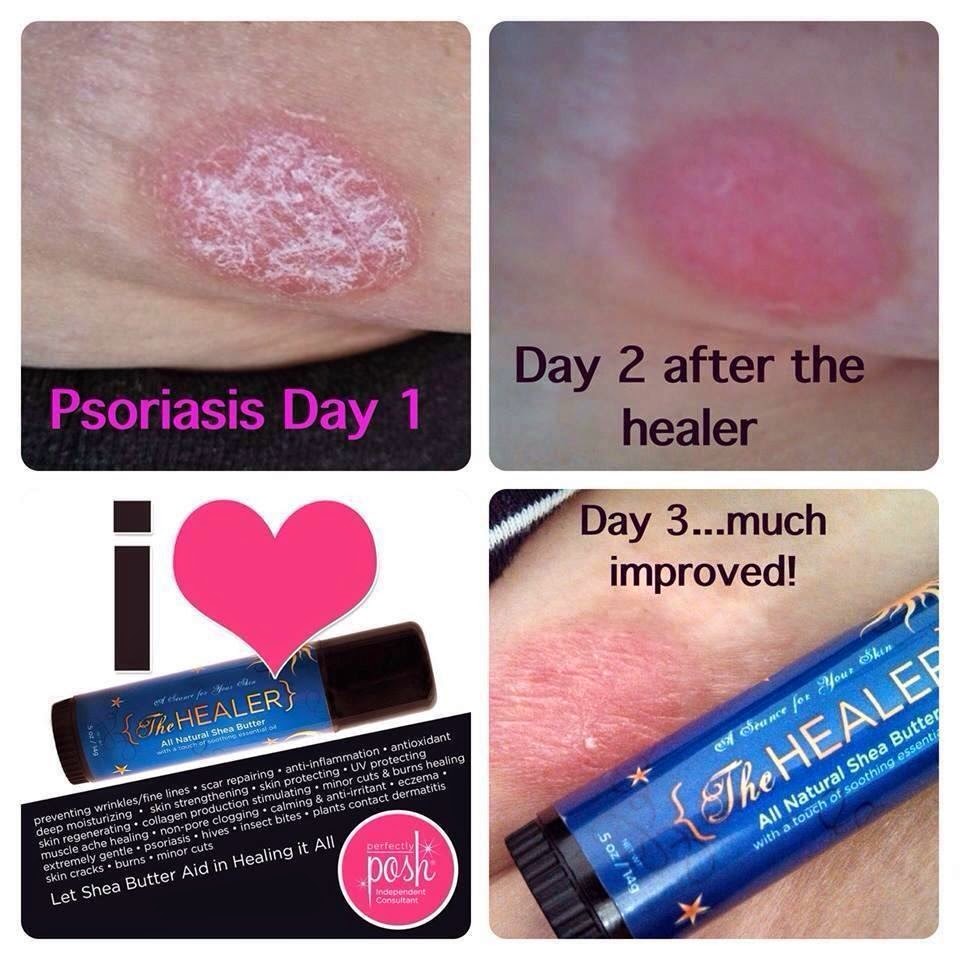 healer-psorisis.jpg