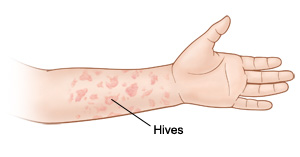 How to get rid of them? When Your Child Has Hives Urticaria Or Angioedema Saint Luke S Health System
