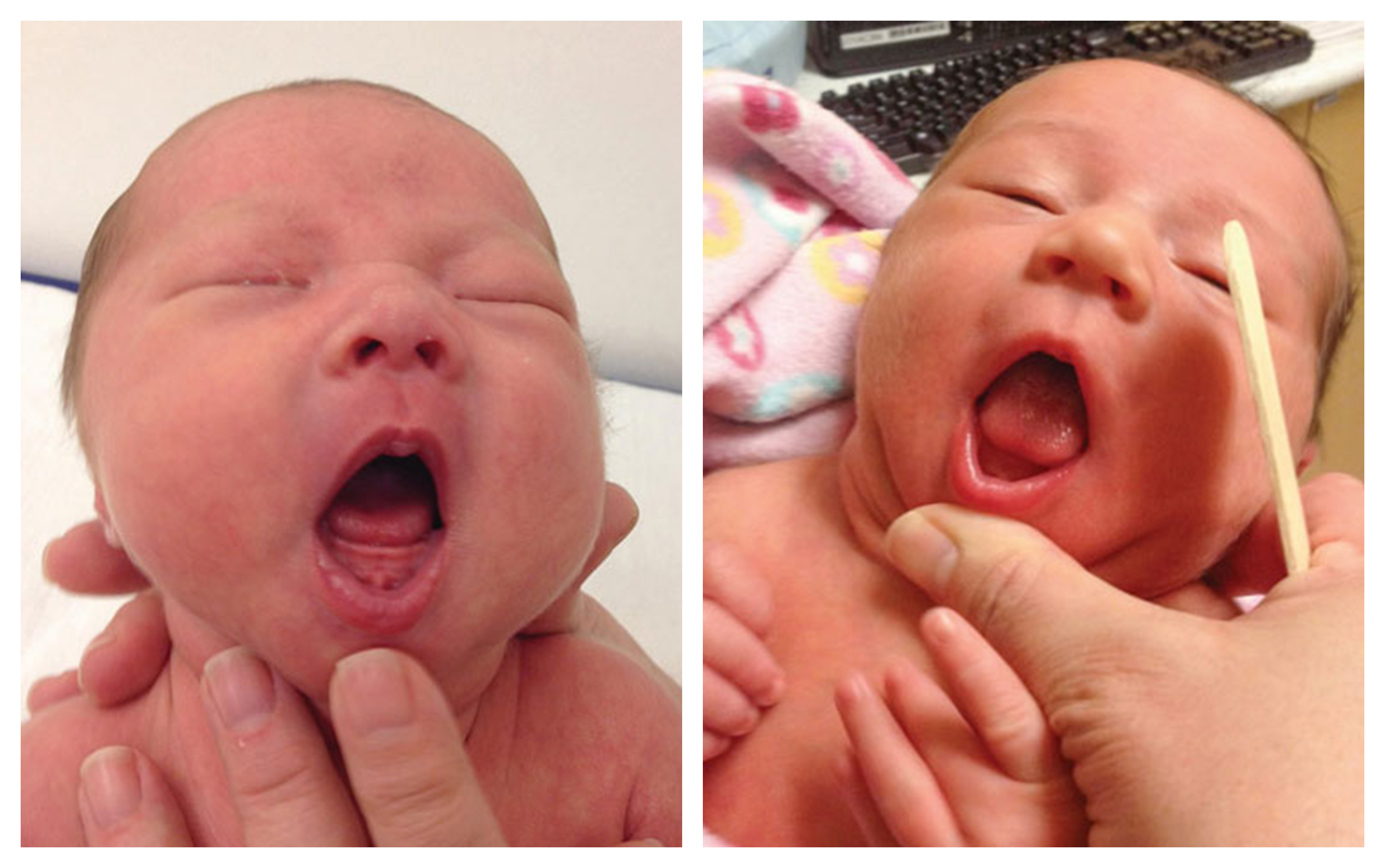 Is Tongue Tie Possibly Overdiagnosed in Infants?