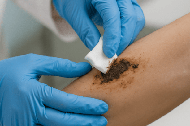 A gloved healthcare worker cleaning a small muddy wound on a forearm in a clinic setting
