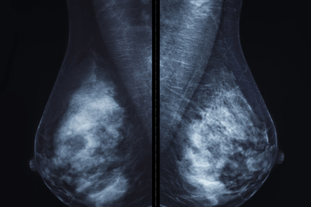 Breast Imaging