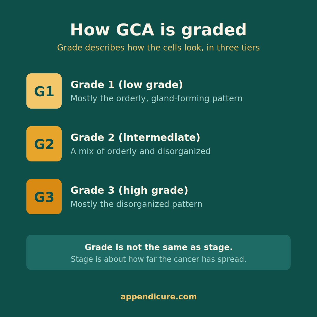 Three-tier grading of goblet cell adenocarcinoma showing grade 1 low grade, grade 2 intermediate, and grade 3 high grade.