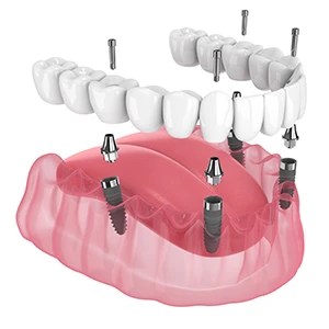 How many implants are needed for all-on-four procedure?