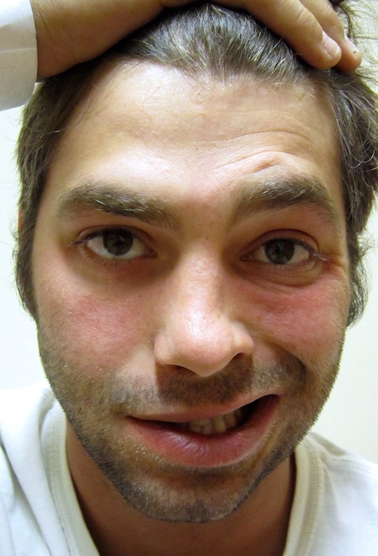 Bell’s palsy Arnold Zwicky's Blog