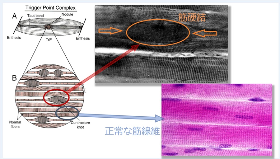 コリのある筋肉繊維と正常な筋肉繊維の図