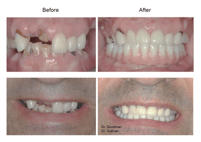 Before and After