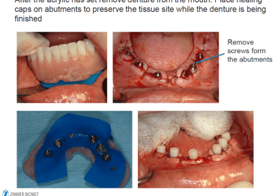 Smart Denture conversion photos