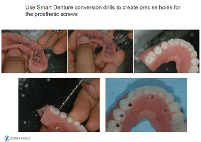 Smart Denture conversion photos