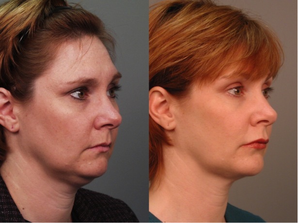 Fine art gallery located in greensboro nc, offering an impressive collection of work by acclaimed artists. Chin Implant Before After Photos | Greensboro GA