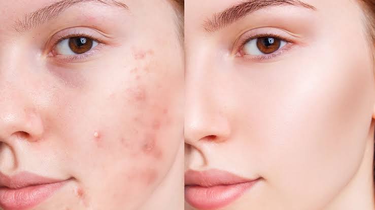 How Eating Just One Clove Daily Transforms Your Skin and Eliminate Stubborn Acne Naturally