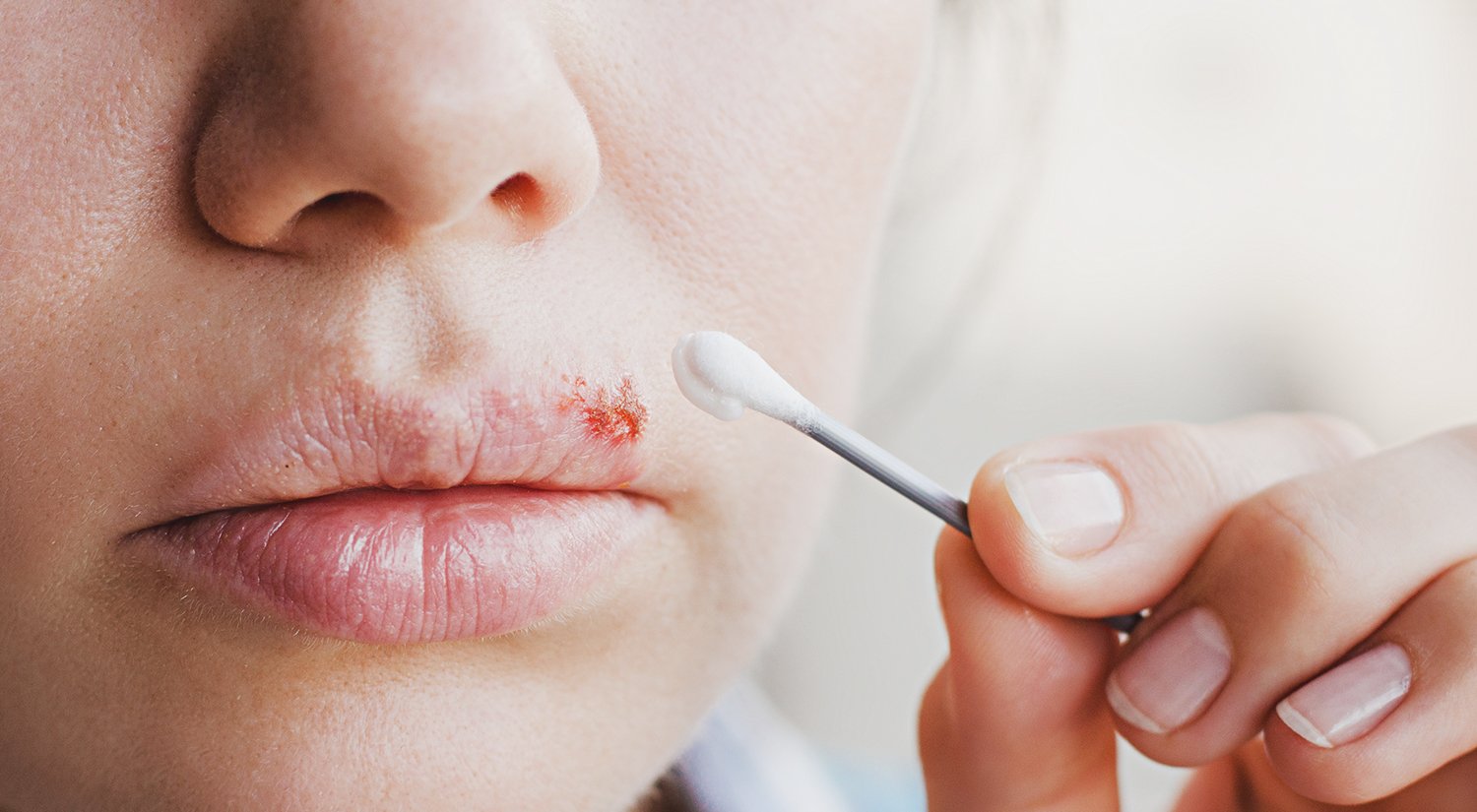pic How To Get Rid Of A Cold Sore Fast On Your Lip ask the dentist