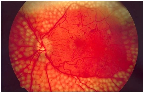 Pan Retinal Photocoagulation