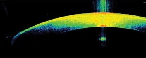 Pachymetry (CCT)