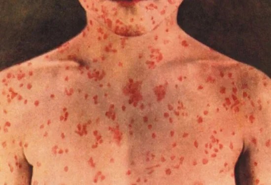 حصيلة مقلقة: 27 ألف إصابة و120 وفاة بسبب الحصبة.. والجمعيات الطبية تحذر من كارثة صحية