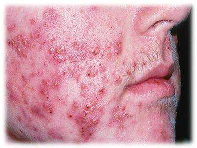 Gunakan produk berbahan retinoid · 3. Cara Menghilangkan Jerawat Batu Secara Alami Dengan Cepat Kompasiana Com