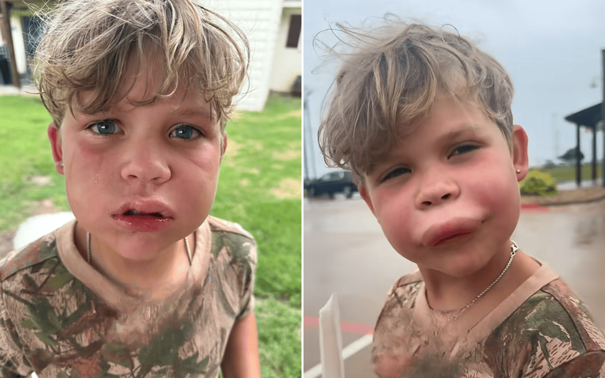 Mom didn’t think son’s wasp sting was “big deal,” then the swelling began