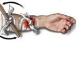 Bleeding Control Assignment Point